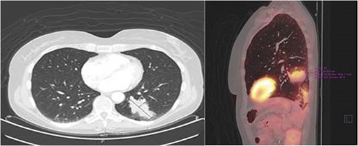Transverse- and sagittal plane of the PET-scan showing a leasion in the left lower lobe with metabolic activity.