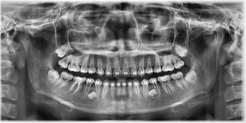 Image depicting the supernumerary premolar buds located between the first and second mandibular premolars.