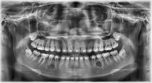 Follow-up panoramic 1 week after removal of the supernumerary premolars.