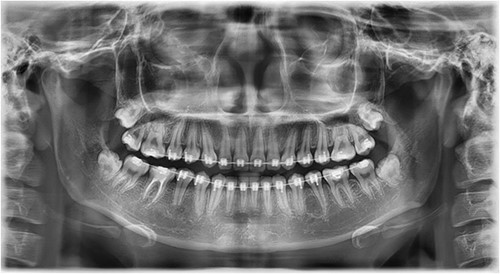 Follow-up panoramic image 1-year after removal of the supernumerary premolars.