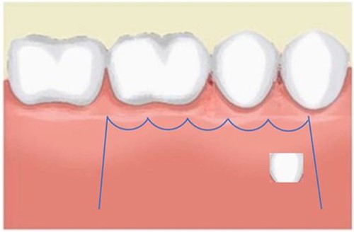 Neumann flap design.
