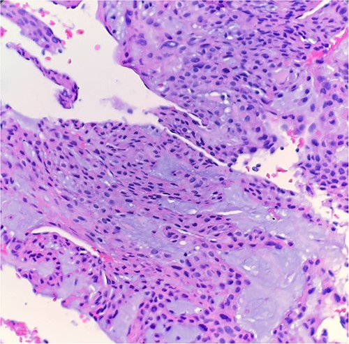 Microscopic examination reveals epithelioid bland tumor cells forming glandular structure with mucinous material. H&E ×40.