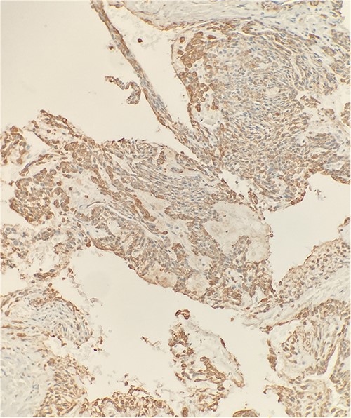 Immunohistochemical stain reveals that tumor cells are positive for SMA. IHC ×20.