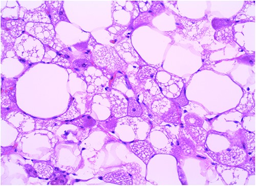 Case 1: hematoxylin and eosin ×20.