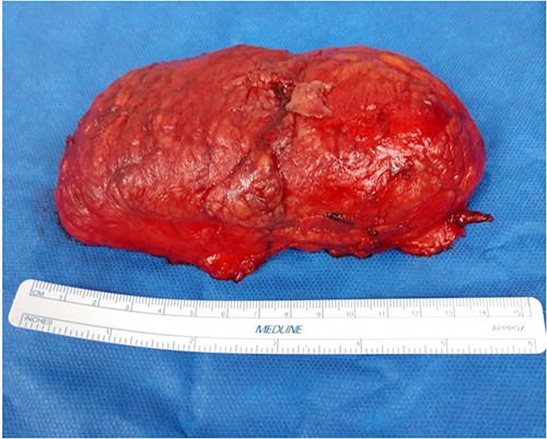 Case 1: gross picture of lesion postoperatively.