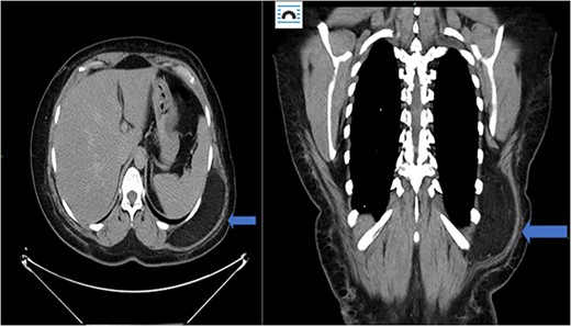 Case 1: CT (axial and coronal view), blue arrow marks hibernoma.