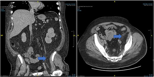 Case 2: CT abdomen and pelvis from November 2022.