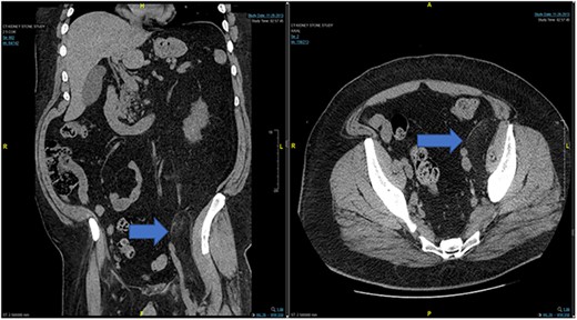 Case 2: prior CT of Case 2 from 2013.