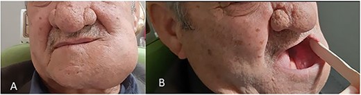 Preoperative views of the lesion. (A) Extraoral evaluation of the lesion showed huge mandibular swelling on the same side with intact skin. (B) Intraoral evaluation of the lesion showed left mandibular swelling with intact mucosa.