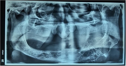 Panoramic view showing irregular multilocular radiolucency from the anterior mandible extending distally to the ramus.