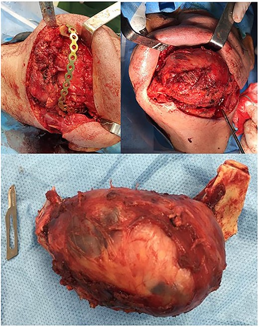 Complete surgical excision of the lesion and reconstruction of the mandible and ramus.