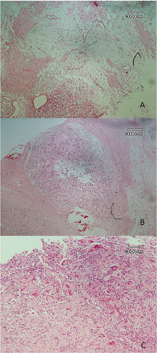 Histopathologic views of the lesion (H&E staining, ×100 magnification). (A) Inflamed fibromyxoid connective tissue. (B) Area of one granulomatous pattern inflammation with multiple giant cells. (C) Numerous foreign body giant cells admixed with severe chronic.