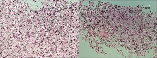 Histopathologic views of the lesion (H&E staining, ×10 magnification). Inflammation in the connective tissue and foreign body giant cells admixed with severe chronic inflammatory cells.