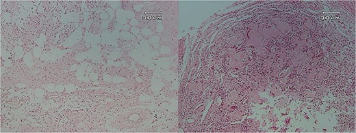 Histopathologic views of the lesion (H&E staining, ×100 magnification). Inflamed fibromyxoid connective tissue and foreign body giant cells.