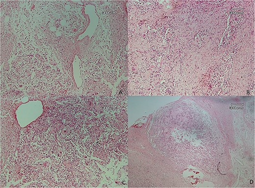 Histopathologic views of the lesion (H&E staining×100 magnification) showing chronic inflammatory cells admixed with multinucleated giant cells of varying sizes.