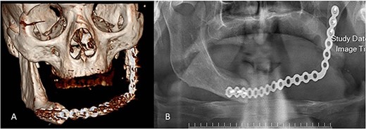 Postoperative radiographs. (A) 3D view of the reconstruction plate. (B) Panoramic view of the reconstruction plate after 24 months.