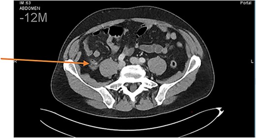 Abdominal CT scan. Diagnosis of uncomplicated acute appendicitis.