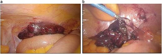 (a) Appendix with 360° anti-clockwise torsion. (b) Detwisted appendix with necrotic-haemorrhagic appearance.