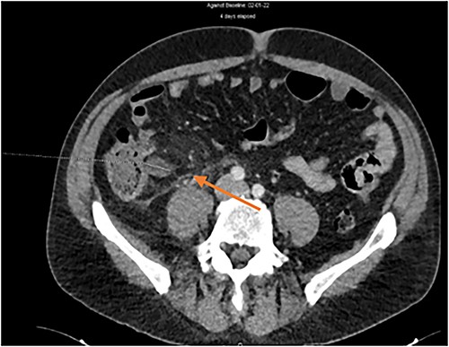 Ileocolic vein thrombosis with peripheric fat inflammation.
