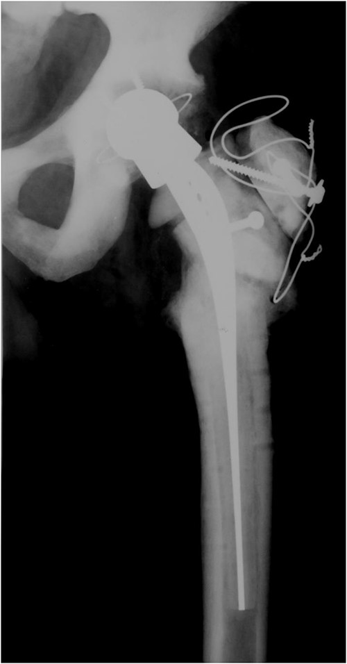 Isoelastic uncemented hip arthroplasty. Broken trochanteric part was fixed with cerclage wires and screws.
