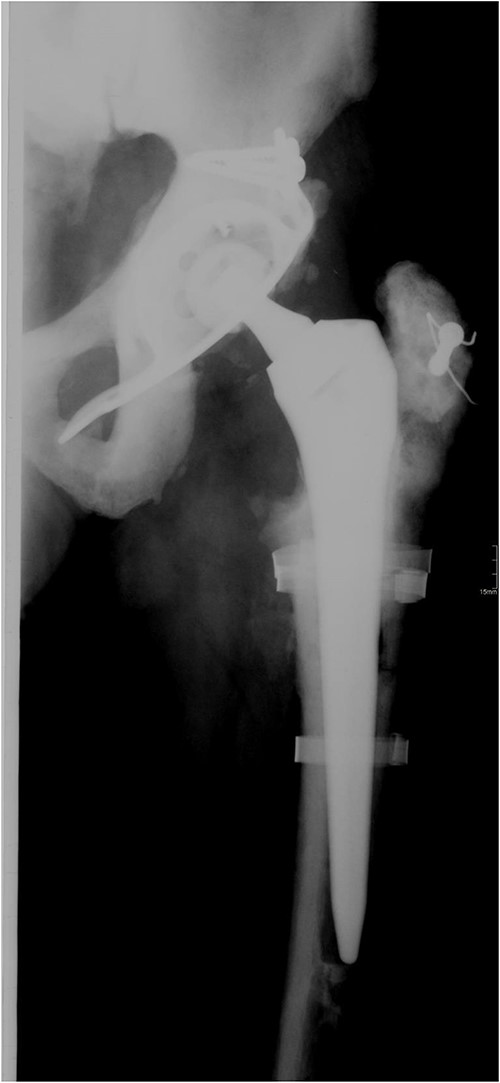 Anteroposterior radiograph of the left hip after revision surgery in 2008.