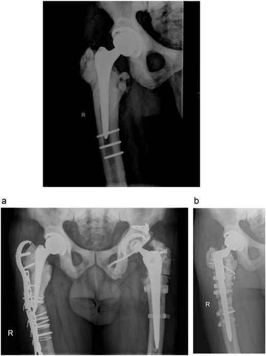 Anteroposterior radiograph of the right hip after THA with three broken residual screws in the distal diaphysis. (a) Anteroposterior hip radiograph with broken lateral plate. (b) Anteroposterior radiograph of the right hip after exchanging the femoral stem.