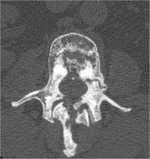 Stress fracture of the left L2 pedicle.