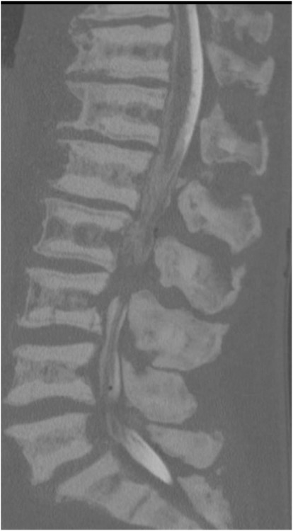 Sagittal view of CT lumbar spine myelography. Note also the density of sclerotic bone.
