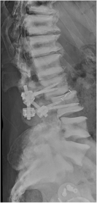 Lateral radiograph of the lumbar spine after failed 360° spondylodesis.