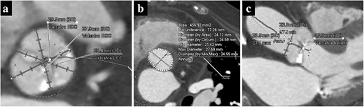 Preoperative computed tomography imaging showing a moderately calcified aortic annulus (a), an annulus area of 457 mm2 (b) and the short height of Valsalva (c).