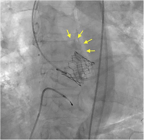 Intraoperative angiography shows a small contrast leakage at the ascending aorta (arrows).