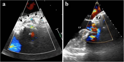 TEE showing the hematoma around the ascending aorta and blood flow at the hematoma at 0 degrees of view (a, arrows), at 120 degrees of view (b, arrows). LA, left atrium; LV, left ventricle; Ao, aorta; AV, aortic valve.