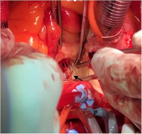 Intraoperative finding shows a tear at the left non-commissure. AV: aortic valve.