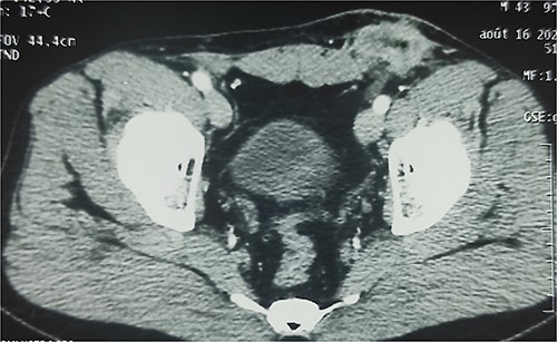 Enhanced CT scan showing well-limited mass in the left inguinal region with heterogeneous enhancement and central hypodensity related to the infected mesh.