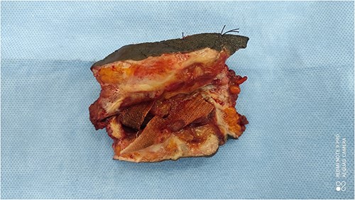 Surgical specimen showing inflammatory granuloma and sinus encircling infected mesh.