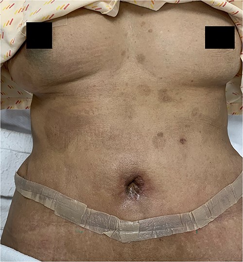 Two weeks post-operatively.