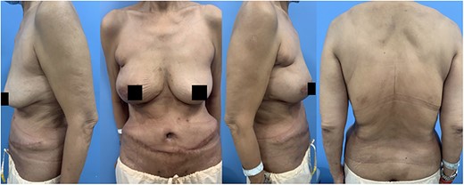 Two months post-operatively.