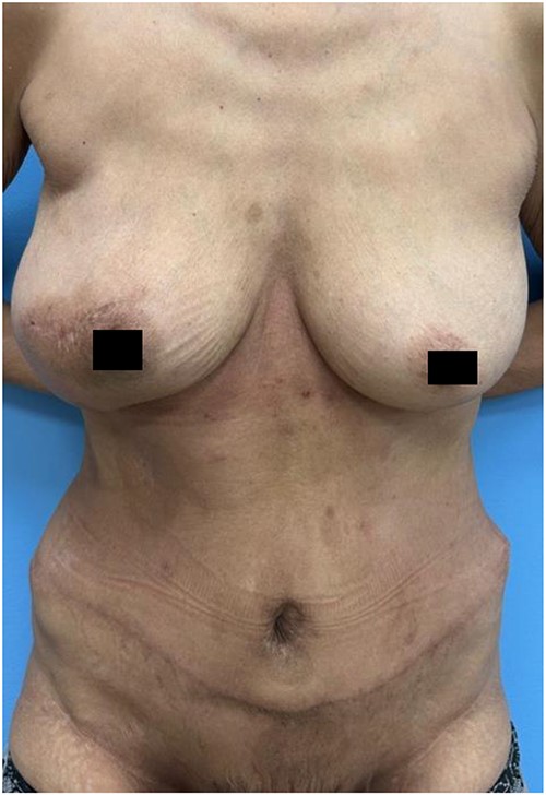 1 year post-operatively.