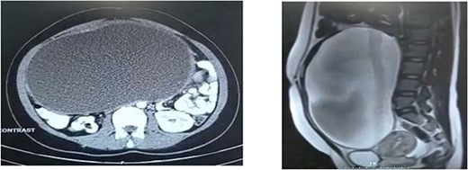 CT scan of the abdomen represents an extension of the mass in two specific views. (a) From the front of the lumbar vertebra to the abdominal wall in horizontal view. (b) Below the peritoneal cavity to the above the bladder in sagittal view.