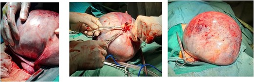 The appearance of massive abdominal mass after tumor excision. (a) Ovarian torsion has occurred secondary to the cyst, along with dark lines indicating a hemorrhagic infarction. (b) Ovarian cystic mass cut from the origin. (c). Dimensions of ovarian cyst.