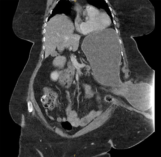 CT abdomen pelvis—coronal view of parastomal hernia containing stomach.