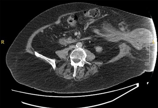 CT abdomen pelvis—axial view of parastomal hernia containing stomach.