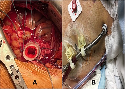 (A) Modified CentriMag™ apical sewing ring; (B) apical access of ProtekDuo RD with Hollister devices