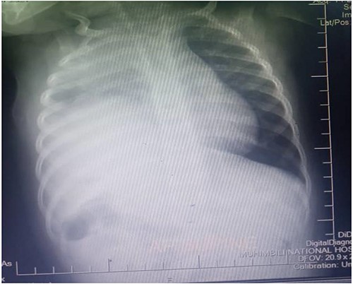 Plain Chest X-ray before surgery.