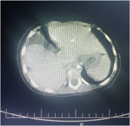 Shows right hemidiaphragmatic rapture.