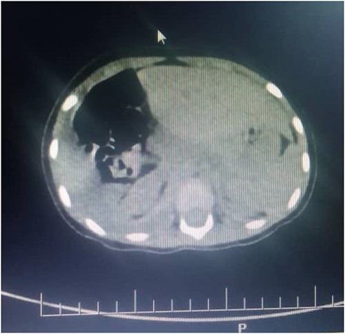 Shows atelectasis of the right lung.