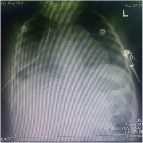 Plain chest x-ray after right hemidiaphragm repair.