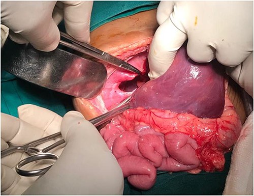 Diaphragmatic defect well appreciable after abdominal viscera retraction.