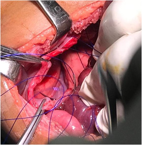 Showing the non-absorbable polypropylene suture (Prolene 2-0) in simple interrupted pattern