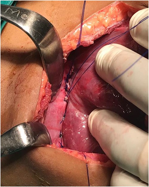 Showing a completely repaired diaphragmatic defect